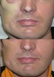 PIGMENTATION DE LAMBEAU CHIRURGICAL