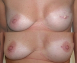 RECONSTRUCTION MAMMAIRE AREOLES AV-AP 