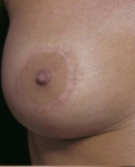 CICATRICE PERIAREOLAIRE AP 