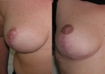 CICATRICE AREOLAIRE